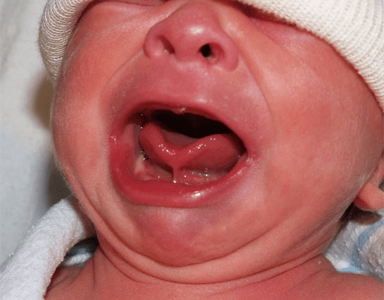 Baby&#8217;s tongue brake: when should you (really) operate?