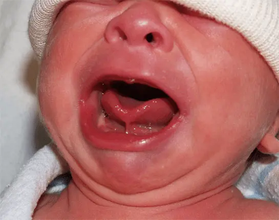 Baby&#8217;s tongue brake: when should you (really) operate?