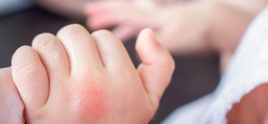 Beware of insect bites in baby