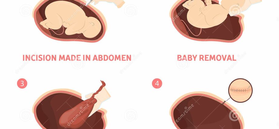 الولادة: مراحل العملية القيصرية