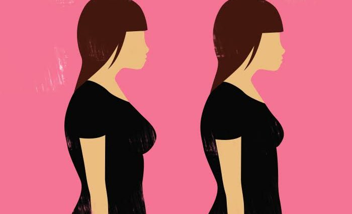 Brystreduksjon, graviditet og amming: hva du trenger å vite