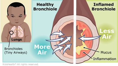 Bronchiolitis in babies