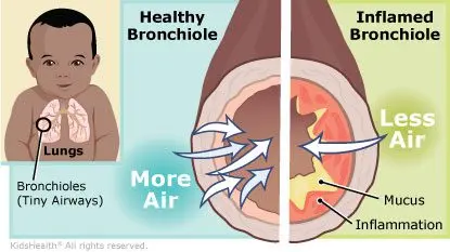 Bronchiolitis in babies