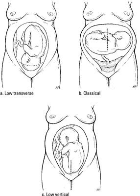 Cesarean section explained to dads