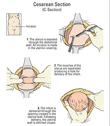 Cesarean section step by step