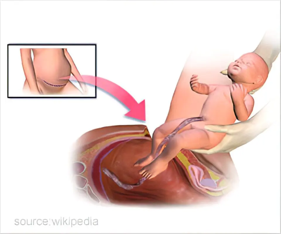 Cesarean section: when and how is it performed?