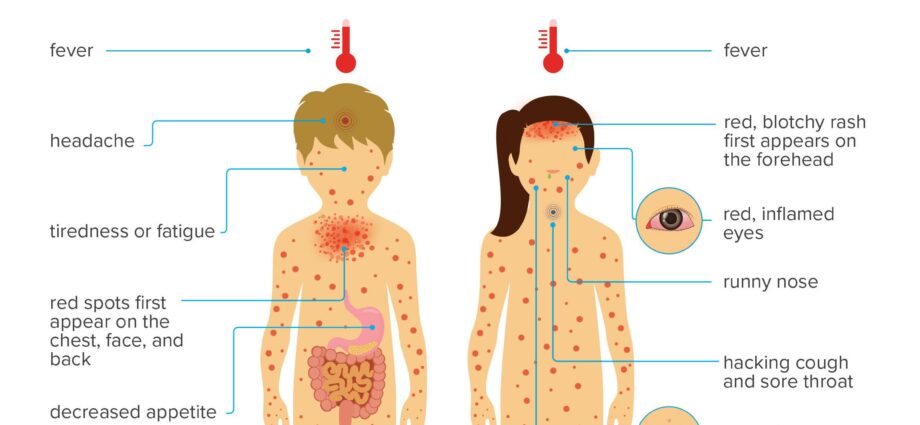 Chickenpox, rubella, measles: these diseases with fever and rash