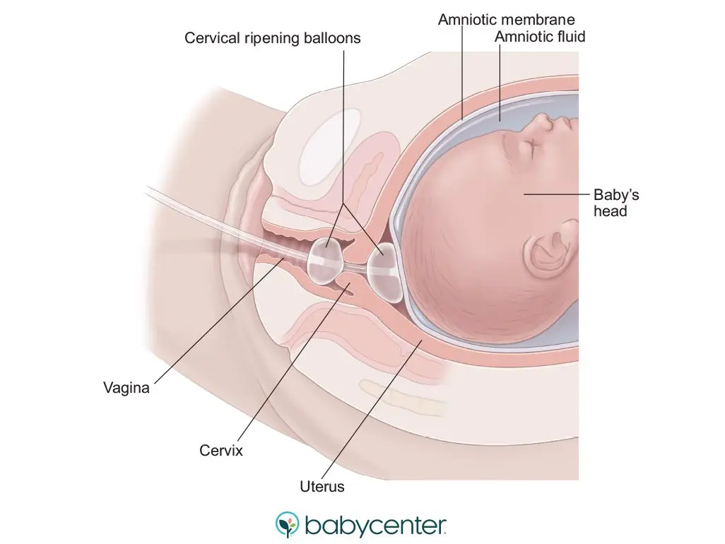 Childbirth: how does an induction happen?