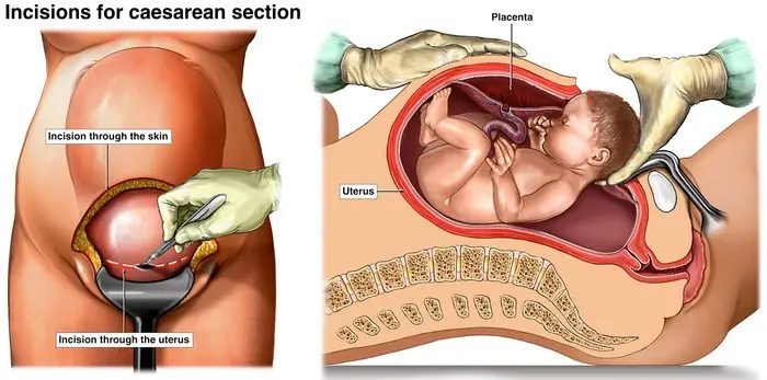 Childbirth: my emergency caesarean section