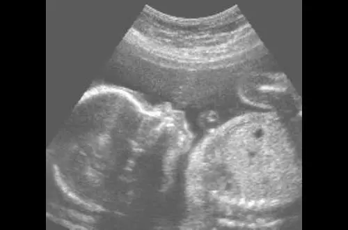 Commercial ultrasounds: beware of drifts