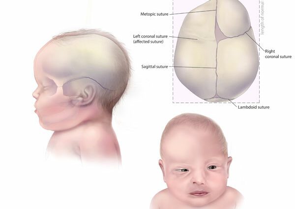 Craniosynostosis: how to detect it in babies?