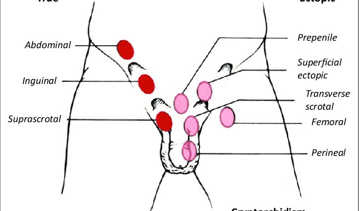 Cryptorchidism and testicular ectopia: what you need to know