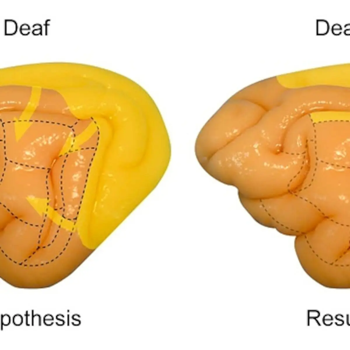 Deafness: how is it going at the nursery?