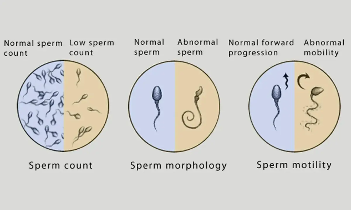 Distilbene: its effects on fertility