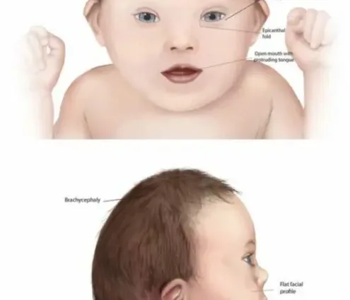 Early detection of Down&#8217;s syndrome