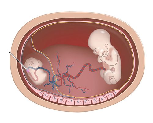 Redución de embrións, que é?