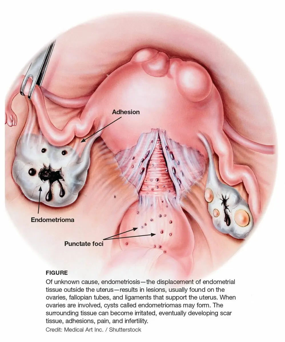 Endometriosis: how to better recognize this disease