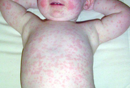 Infektsioosne erüteem ehk "viies haigus": levinud haigus lastel