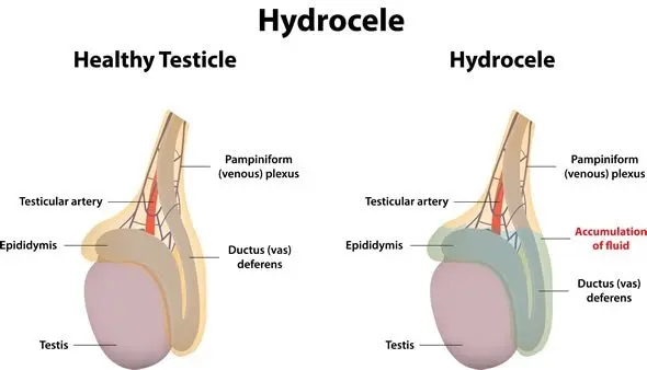 Everything about testicular hydrocele, in adults, children or babies