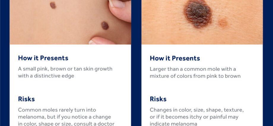 Everything you need to know about birthmarks in babies