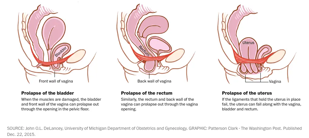 Everything you need to know about prolapse, or organ descent