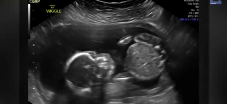 Fetus: 10 unusual ultrasounds