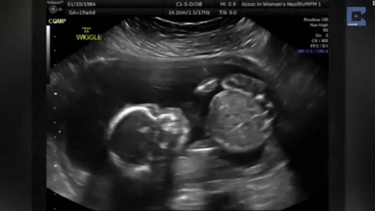 Fetus: 10 unusual ultrasounds