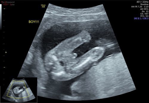 Kudziwa jenda la mwana pa ultrasound