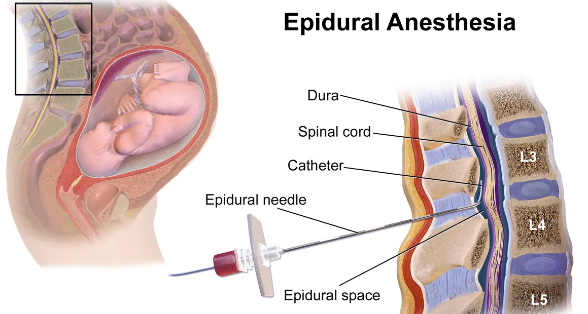 For or against the epidural ?