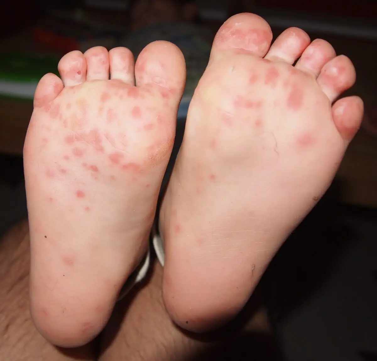 Hand-foot-mouth disease in babies