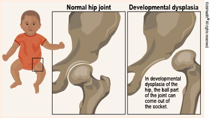 Hip colds in babies