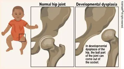 Hip colds in babies