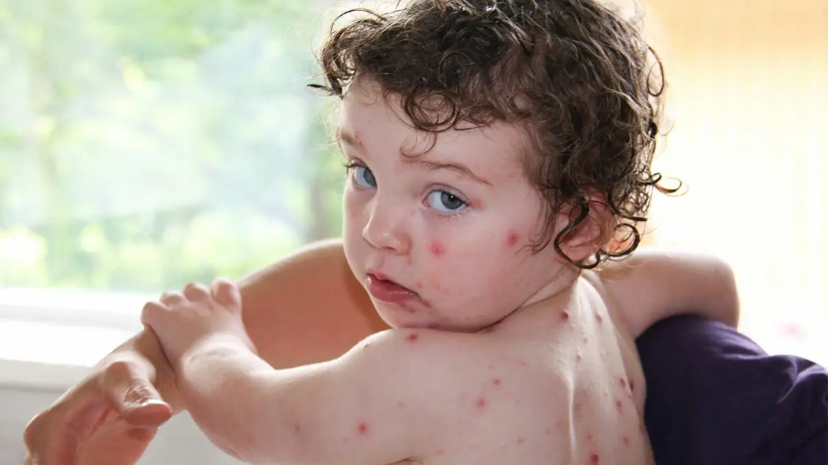 How to recognize chickenpox in children?