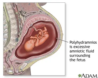 Hydramnios: when the amniotic fluid is in excess