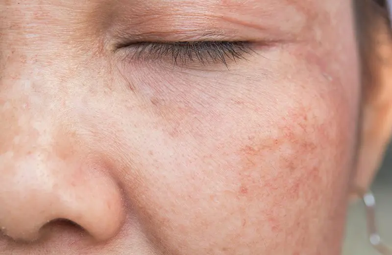 Hyperpigmentation: how to prevent and treat the pregnancy mask?