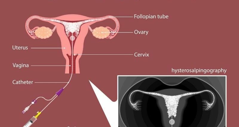 子宫输卵管造影：您需要了解的有关此检查的所有信息