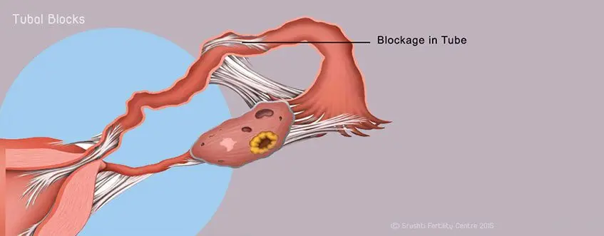 Infertility: tubal abnormalities