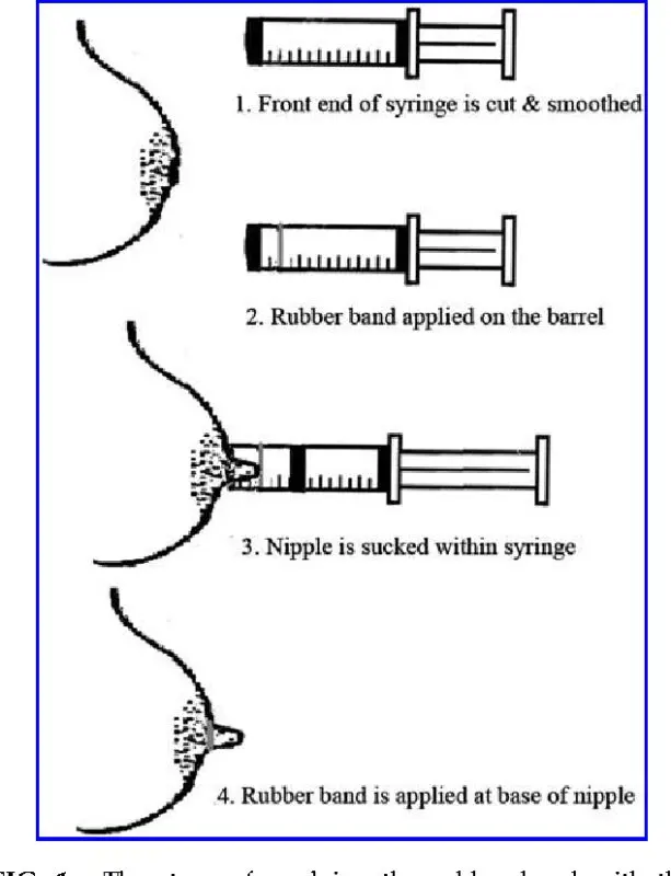 Inverted nipples: are they a barrier to breastfeeding?