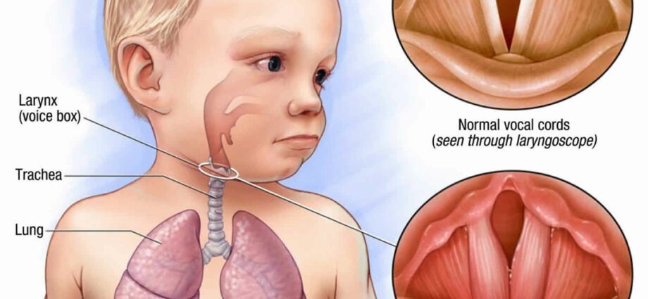 Laryngitis in babies