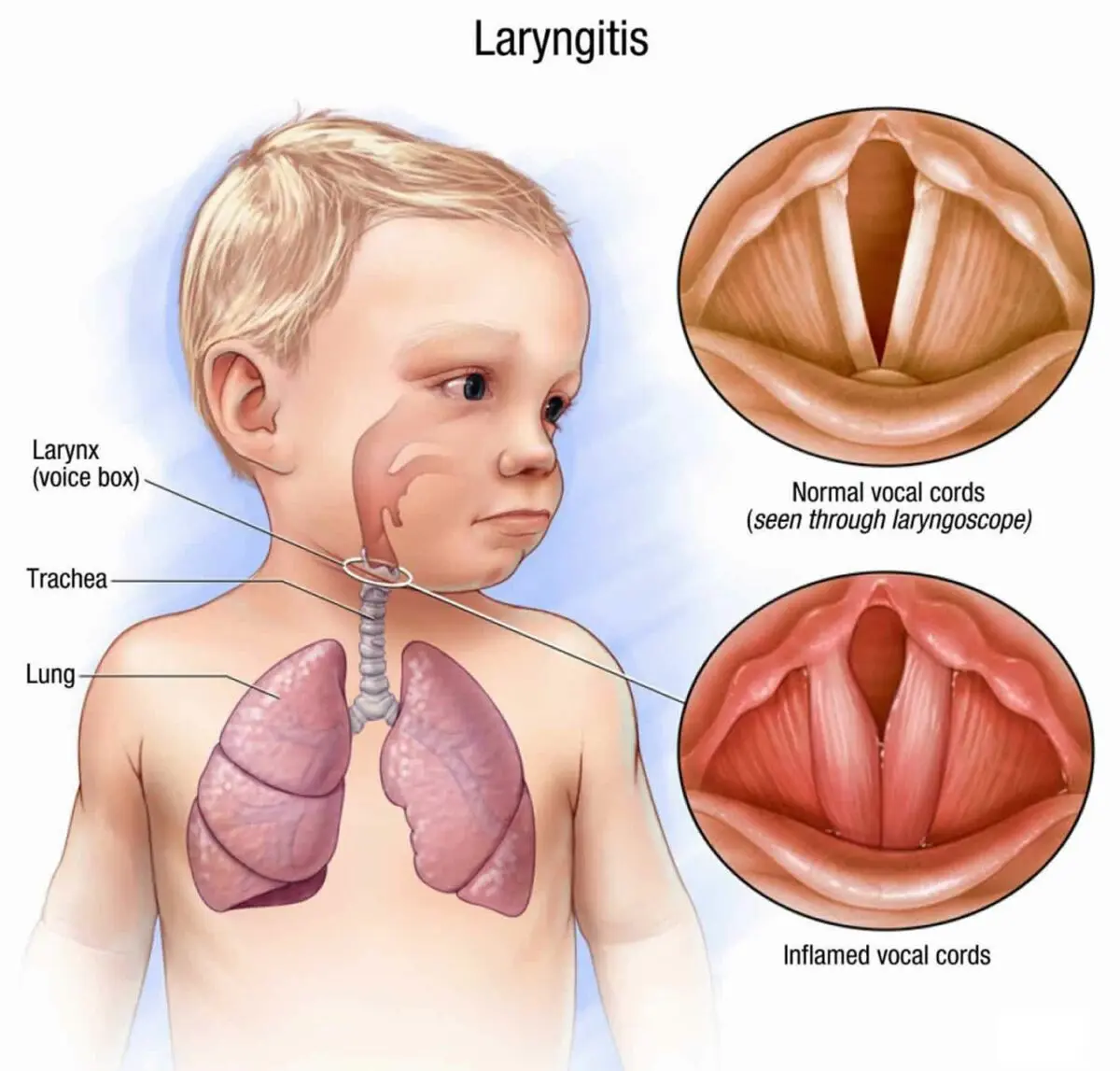 Laryngitis in babies