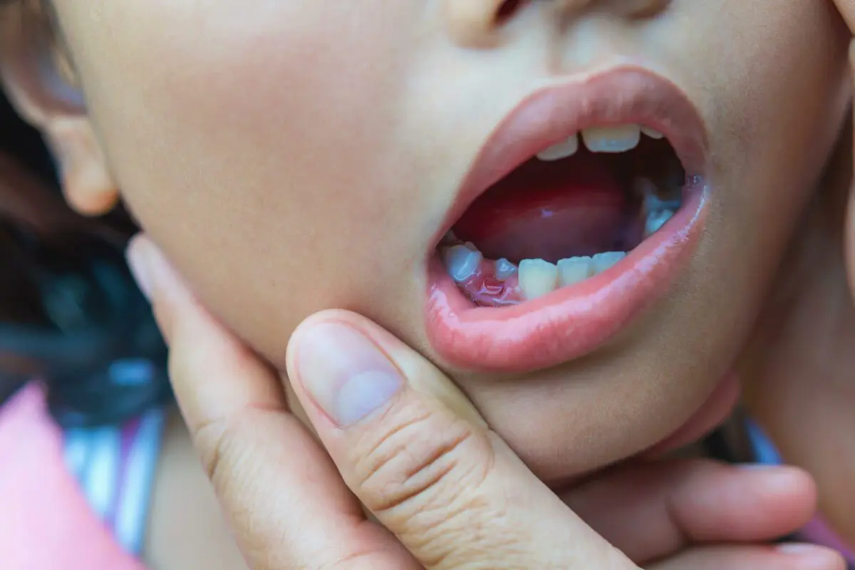 Loss of baby teeth: should children be told about the Little Mouse?