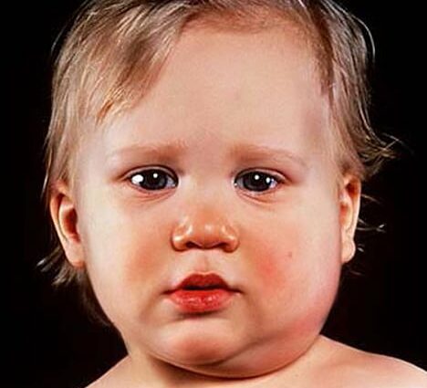 Mumps pri otrocih
