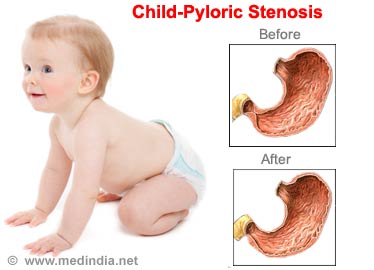 My baby has pyloric stenosis