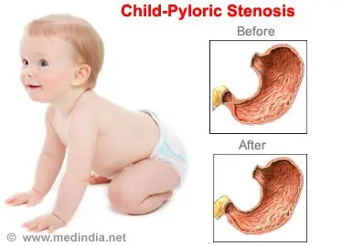 My baby has pyloric stenosis