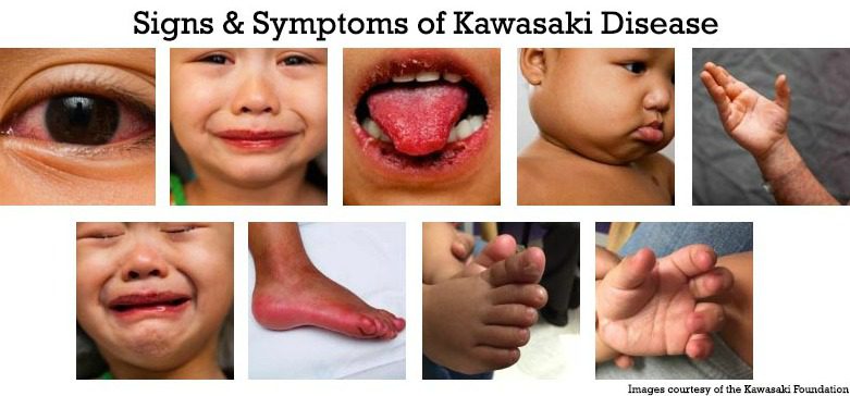 O meu fillo ten a enfermidade de Kawasaki