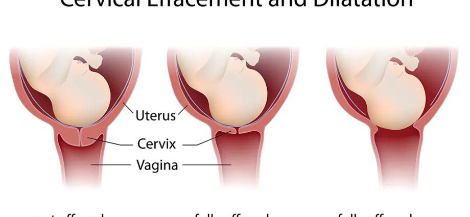 प्रसव के दौरान गर्भाशय ग्रीवा का खुलना या फैलाव