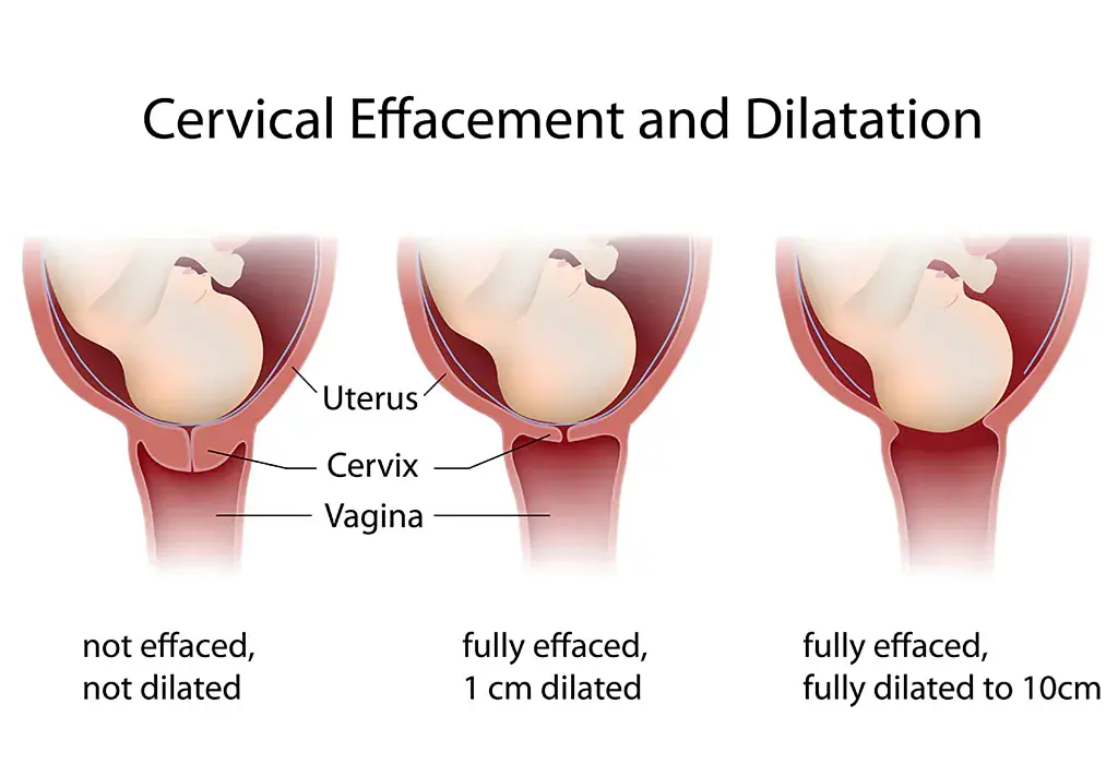 Opening of the cervix or dilation during labor