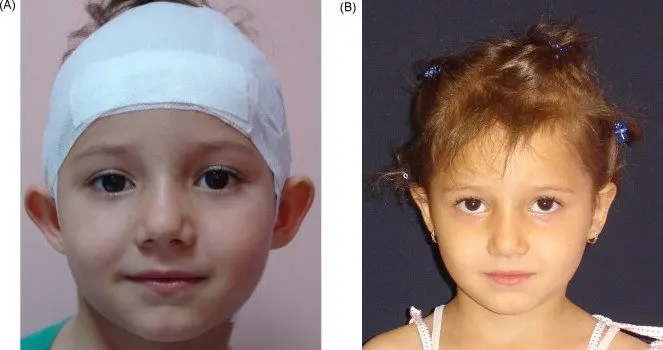 Otoplasty in children