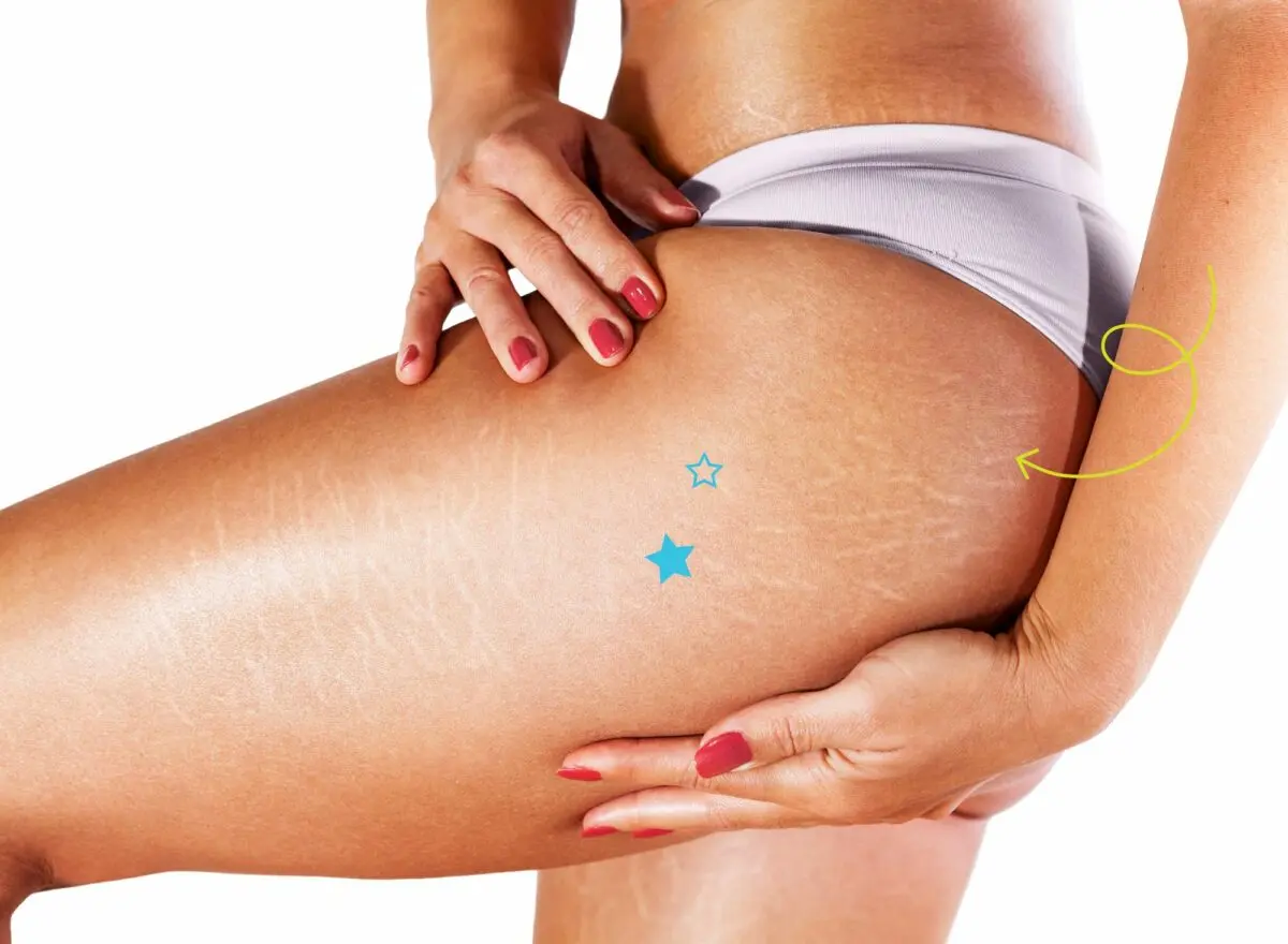 Our selection of anti-stretch mark treatments