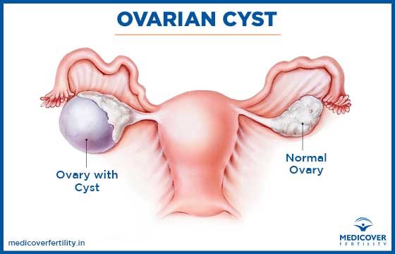 Ovarian cyst and risk of infertility